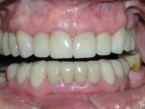 Porcelain Veneers Before And After