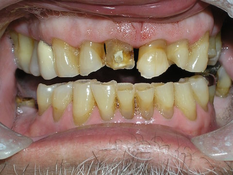 Porcelain Veneers Before And After