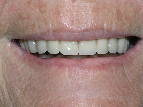 Porcelain Veneers Before And After