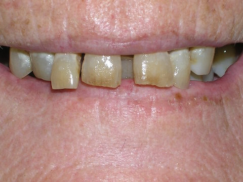 Porcelain Veneers Before And After