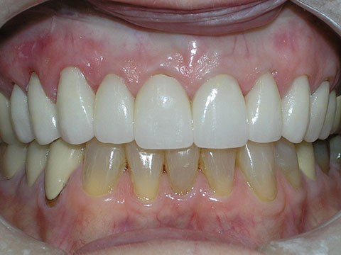 Porcelain Veneers Before And After