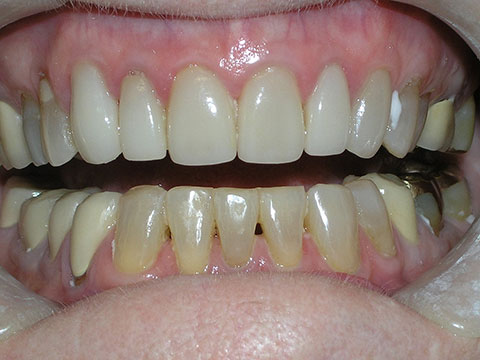 Porcelain Veneers Before And After