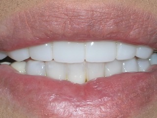 Porcelain Veneers Before And After