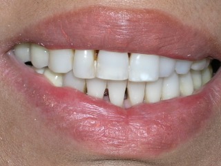 Porcelain Veneers Before And After