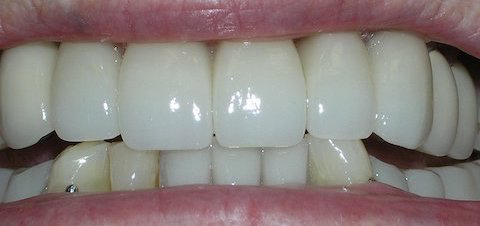 Porcelain Veneers Before And After