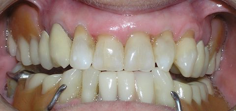 Porcelain Veneers Before And After