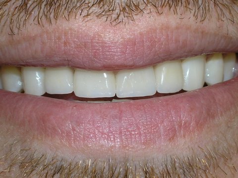 Porcelain Veneer After Photo