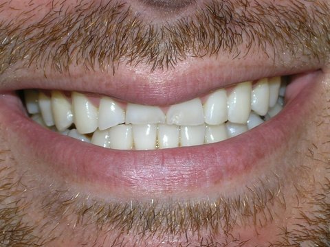 Porcelain Veneers Before And After