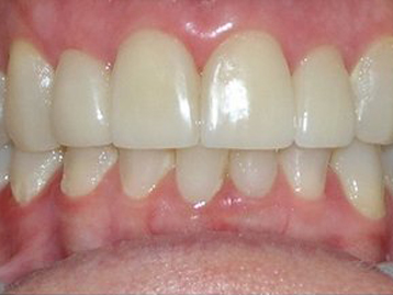 Porcelain Veneers Before And After