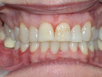 Porcelain Veneers Before And After