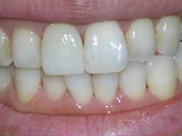 Porcelain Veneers Before And After