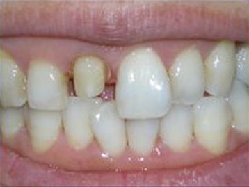 Porcelain Veneers Before And After