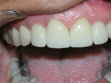 Porcelain Veneers Before And After