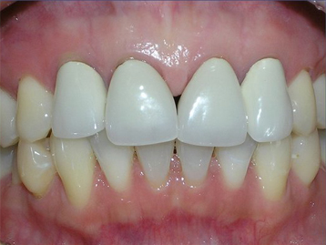 Porcelain Veneers Before And After