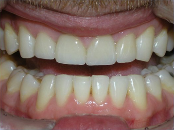 Porcelain Veneers Before And After