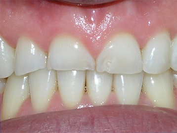 Porcelain Veneers Before And After