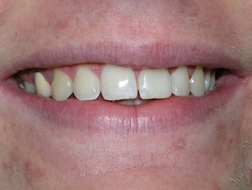 Porcelain Veneers Before And After