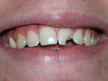 Porcelain Veneers Before And After